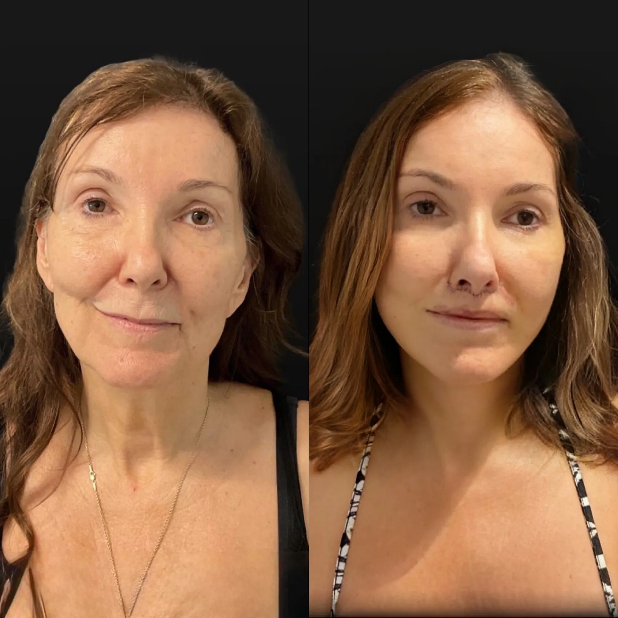 Face & Neck Lift, before and after, patient of Dr. Christine Bokman