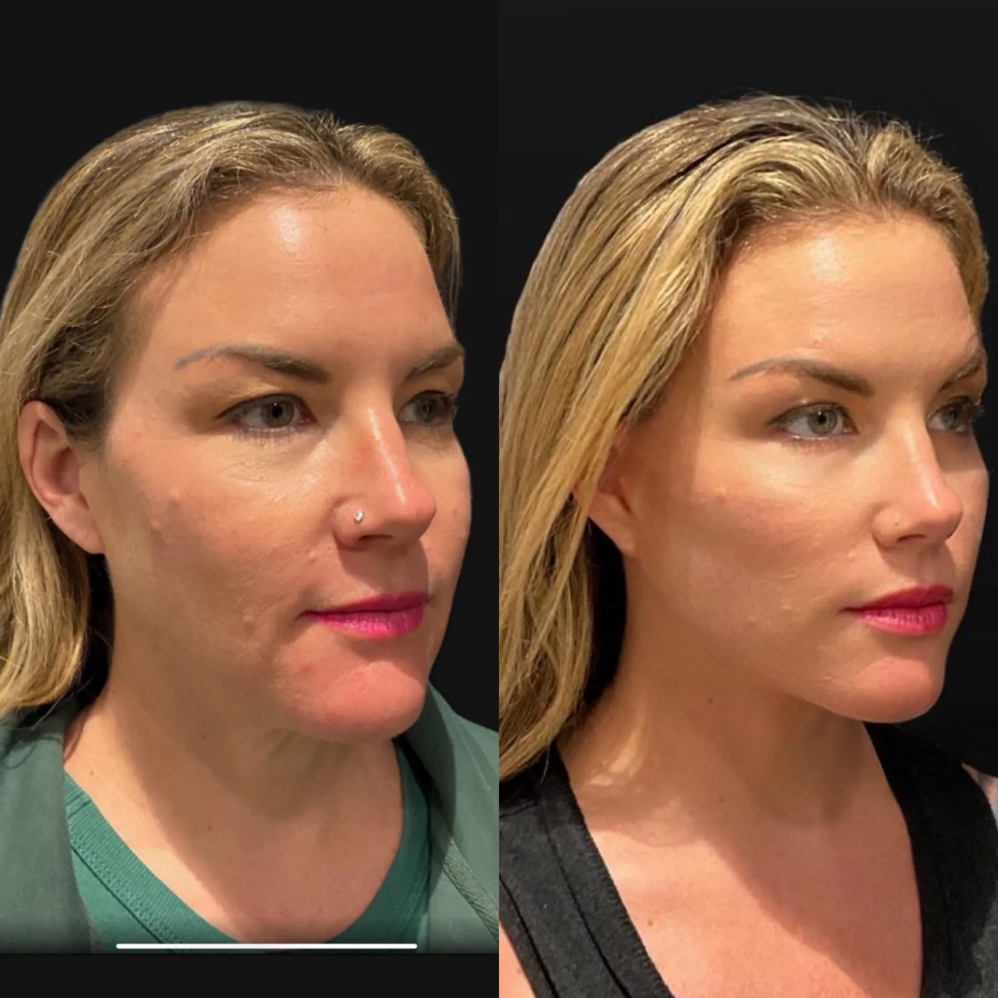Face & Neck Lift, before and after, patient of Dr. Christine Bokman