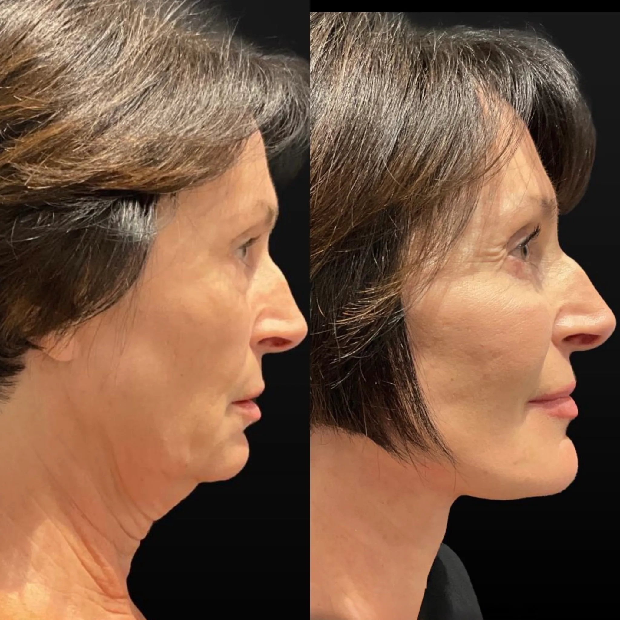 Facelift Neck Lift & Lower Blepharoplasty, before and after, patient of Dr. Christine Bokman
