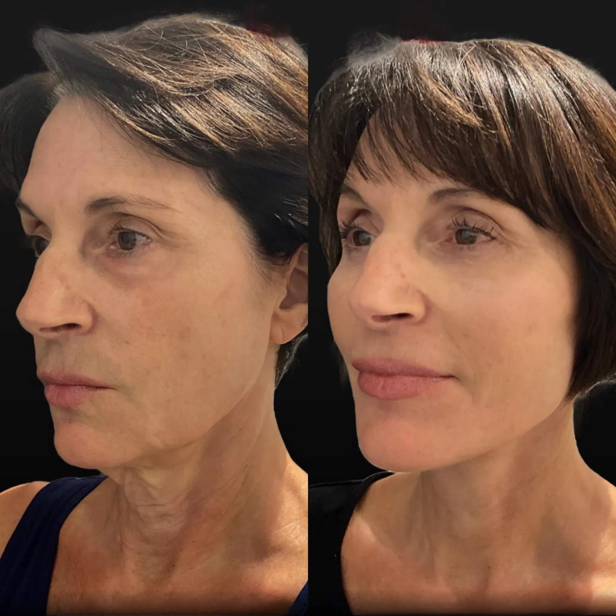 Facelift Neck Lift & Lower Blepharoplasty, before and after, patient of Dr. Christine Bokman
