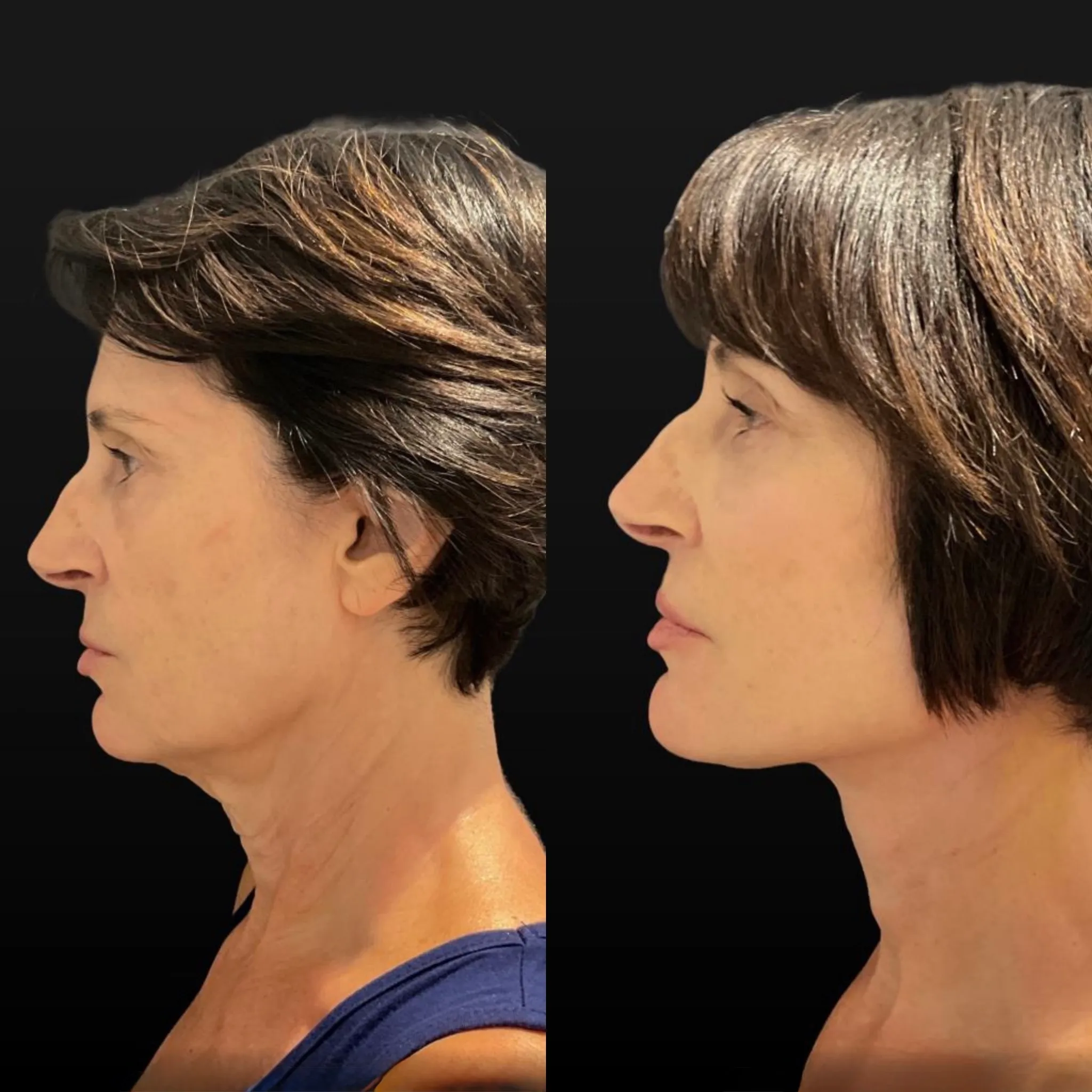 Facelift Neck Lift & Lower Blepharoplasty, before and after, patient of Dr. Christine Bokman