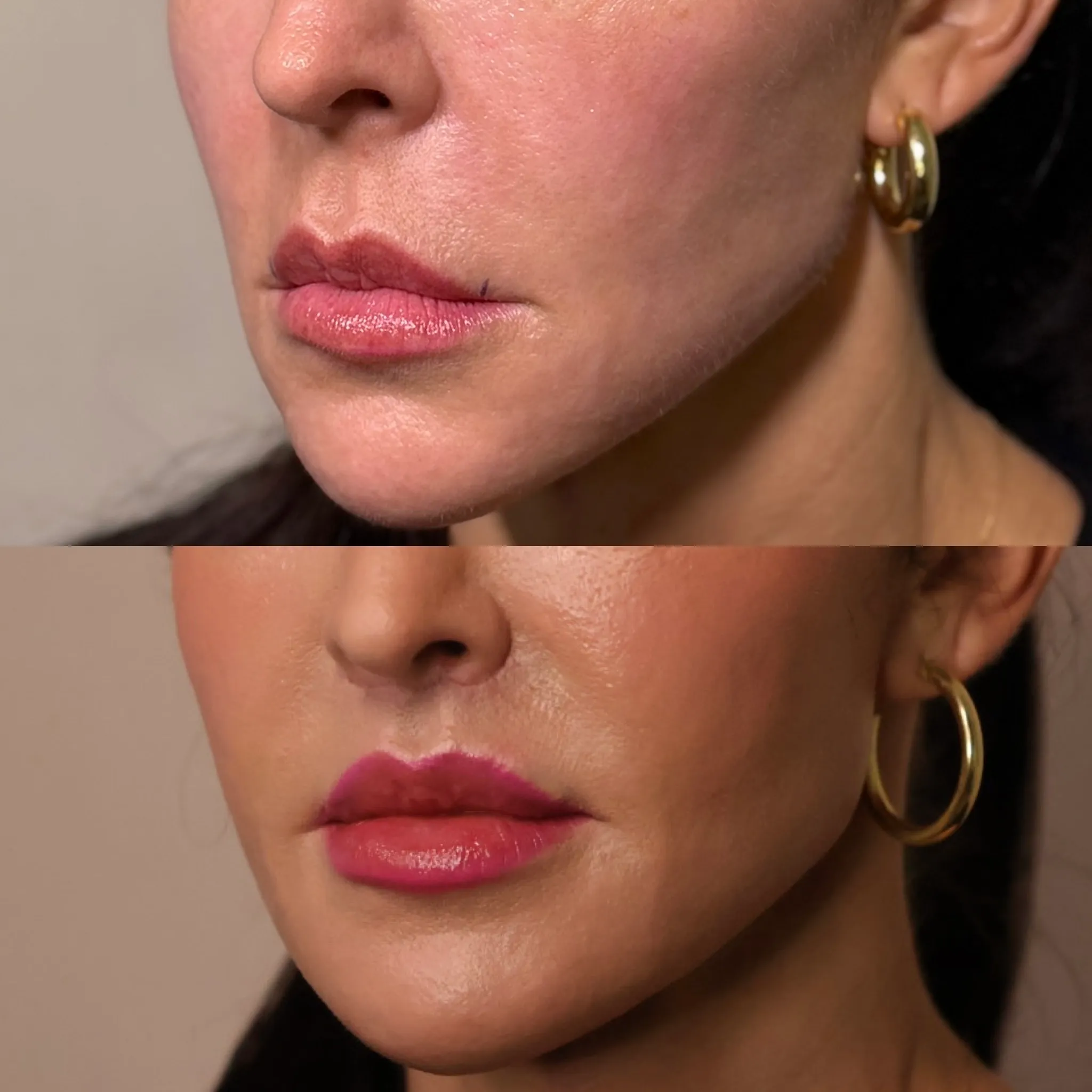 Lip Lift, before and after, patient of Dr. Christine Bokman