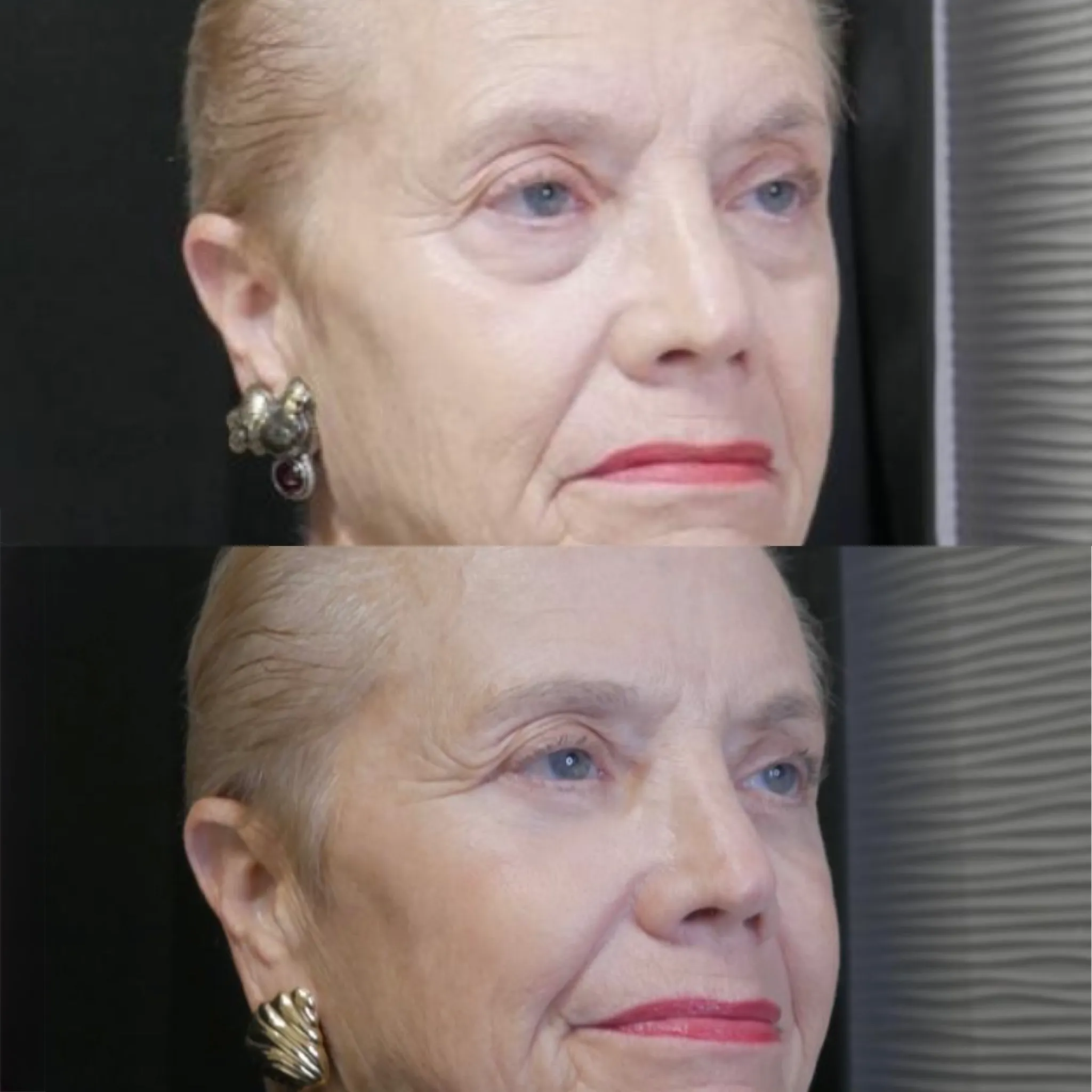 Lower Blepharoplasty, before and after, patient of Dr. Christine Bokman