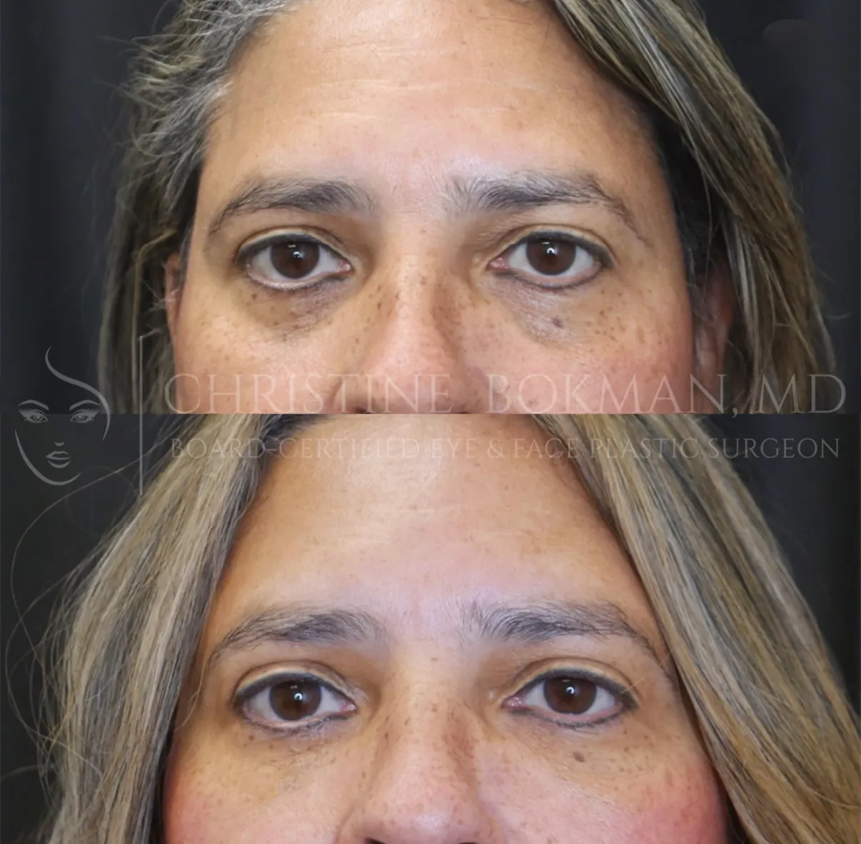 Lower Eyelid Filler, before and after, patient of Dr. Christine Bokman