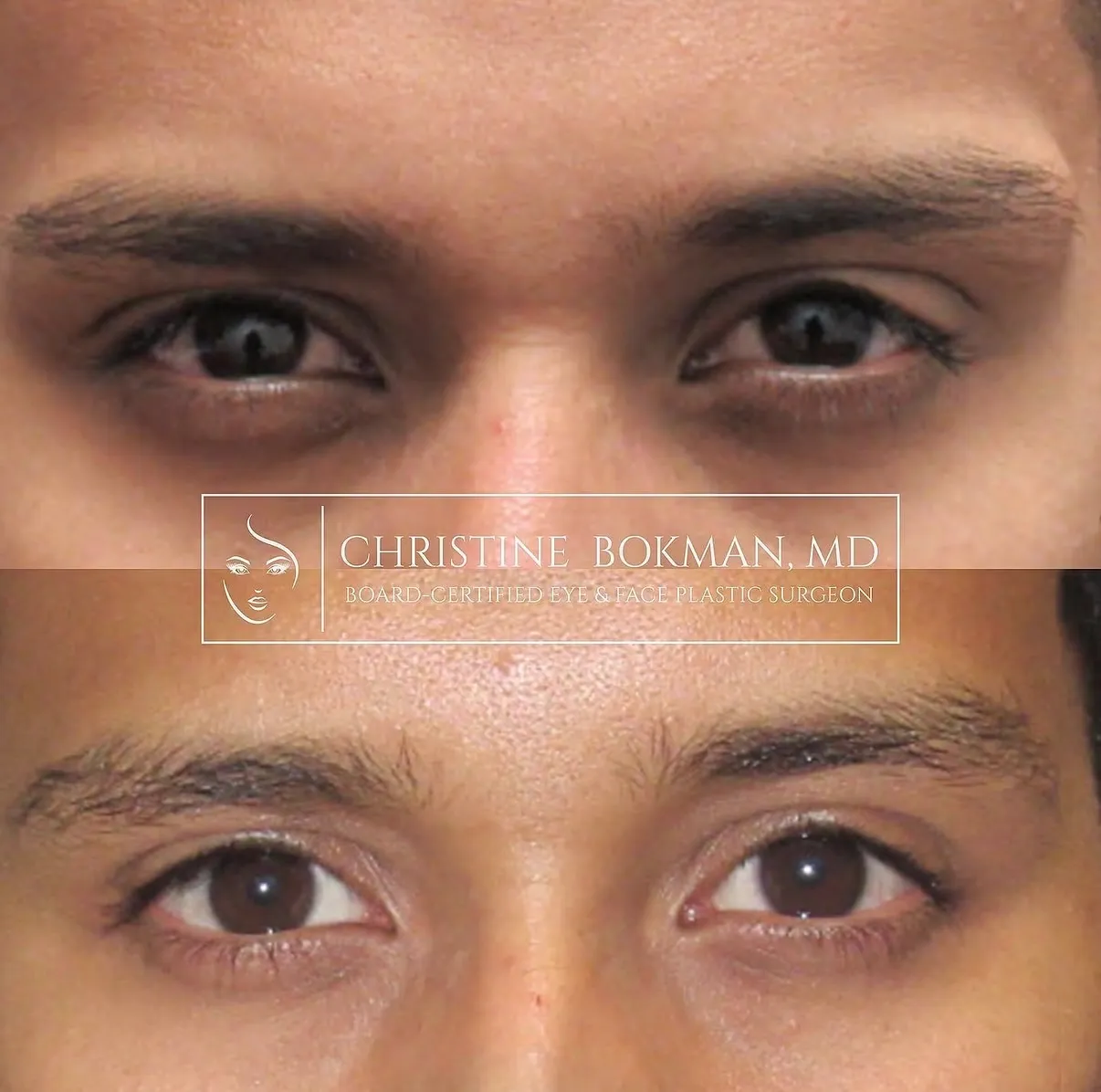 Lower Eyelid Filler, before and after, patient of Dr. Christine Bokman