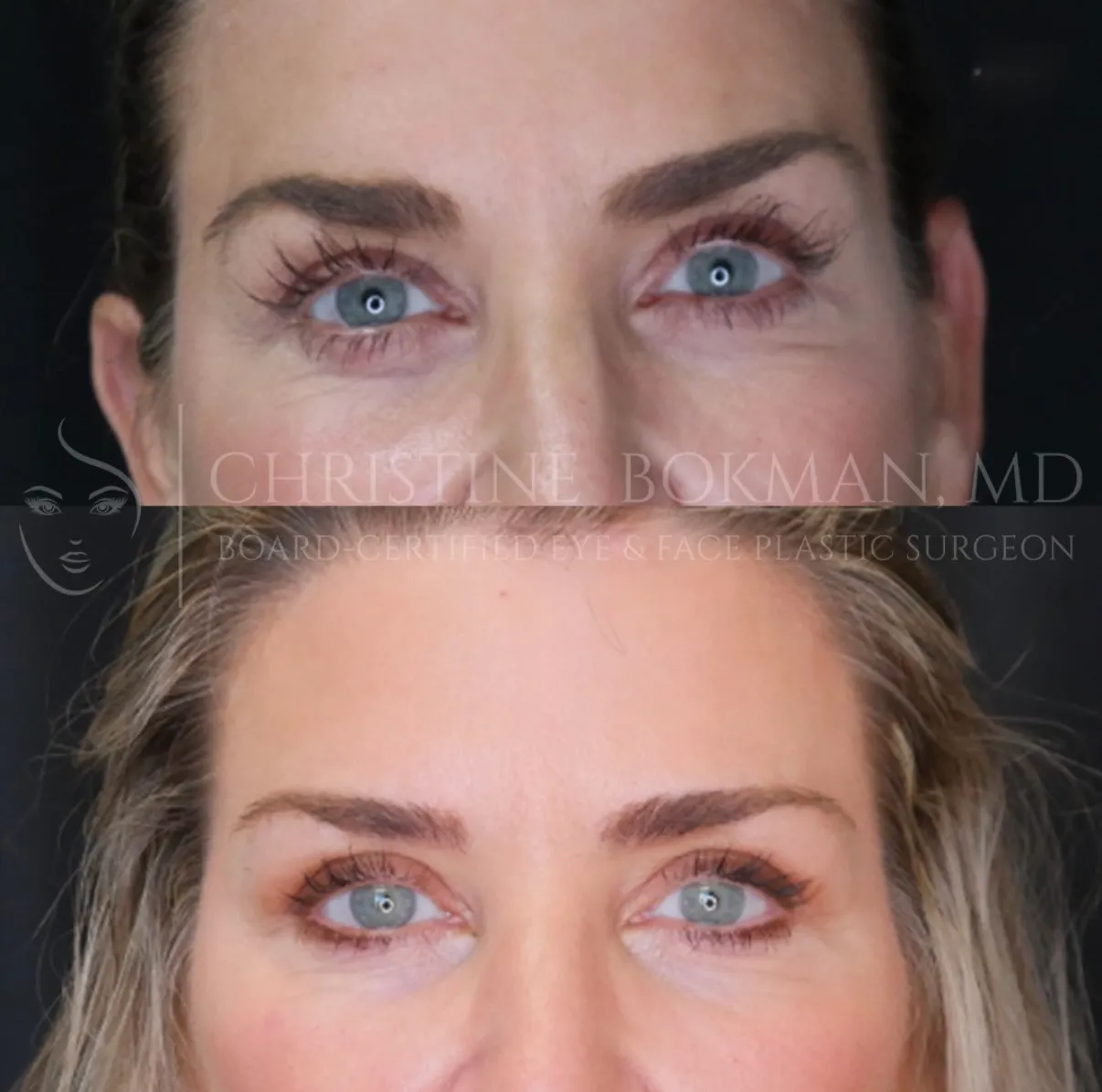 Temporal Brow Lift & Blepharoplasty, before and after, patient of Dr. Christine Bokman