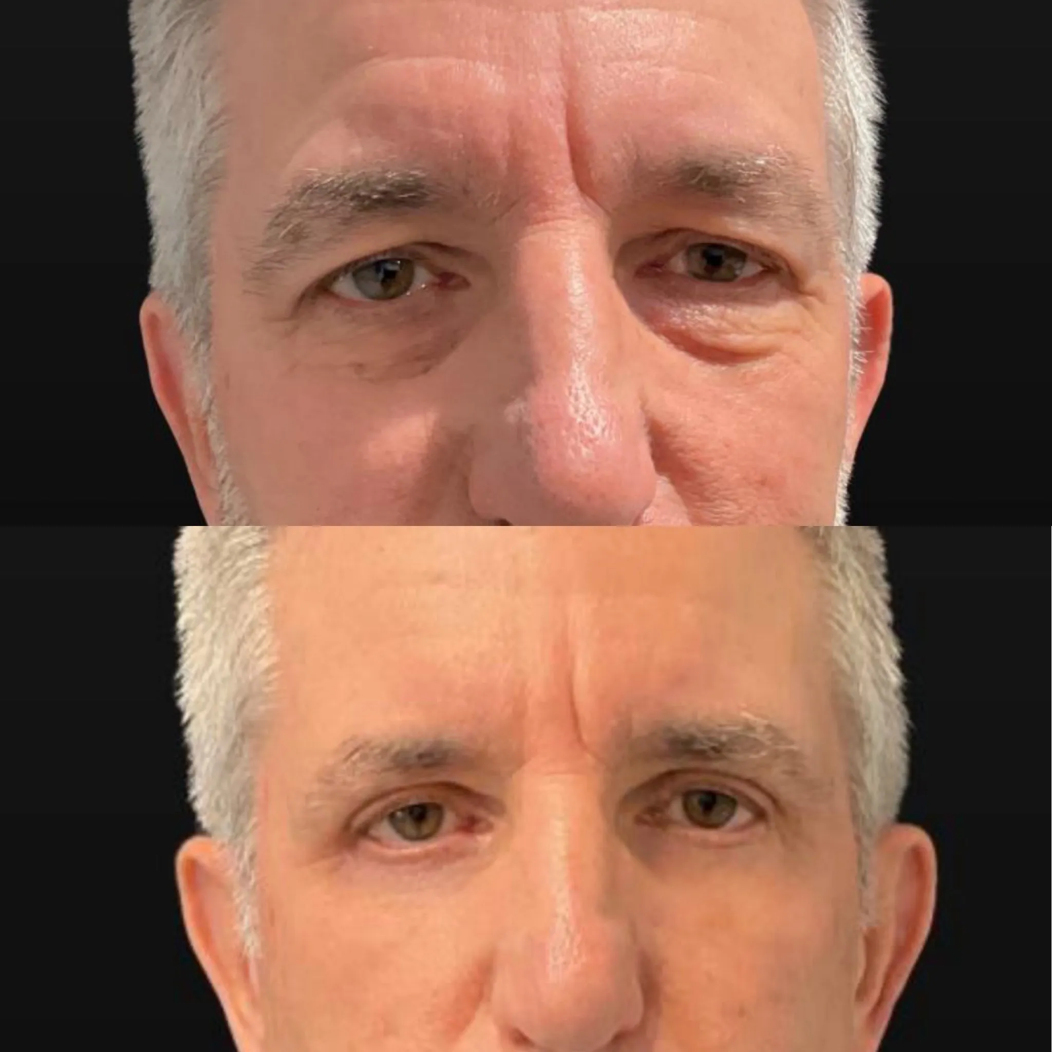 Upper & Lower Blepharoplasty, before and after, patient of Dr. Christine Bokman