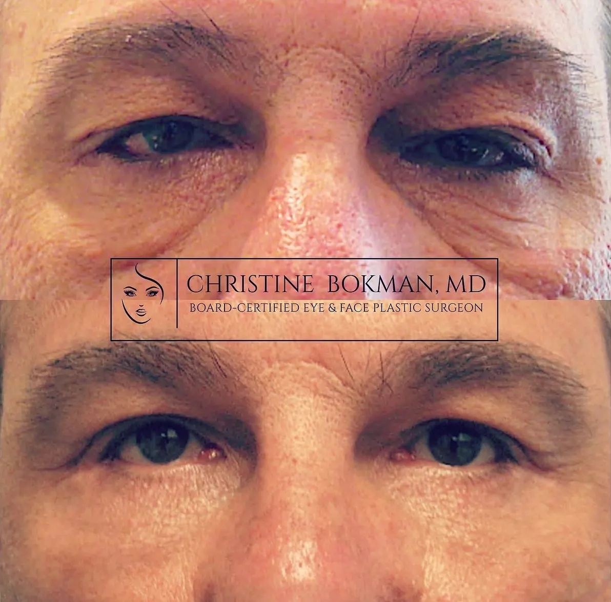 Upper & Lower Blepharoplasty, before and after, patient of Dr. Christine Bokman