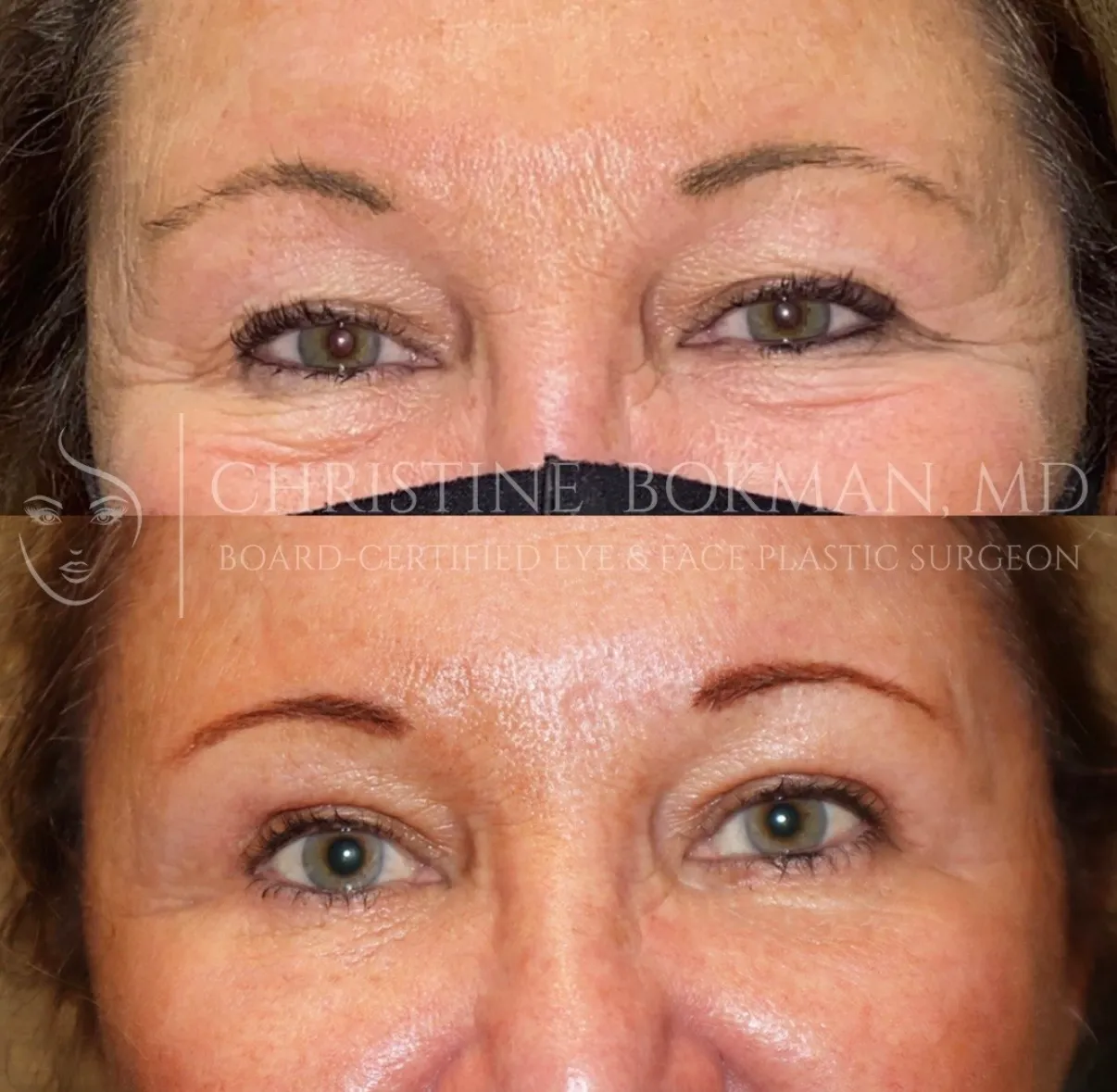 Upper & Lower Blepharoplasty, before and after, patient of Dr. Christine Bokman
