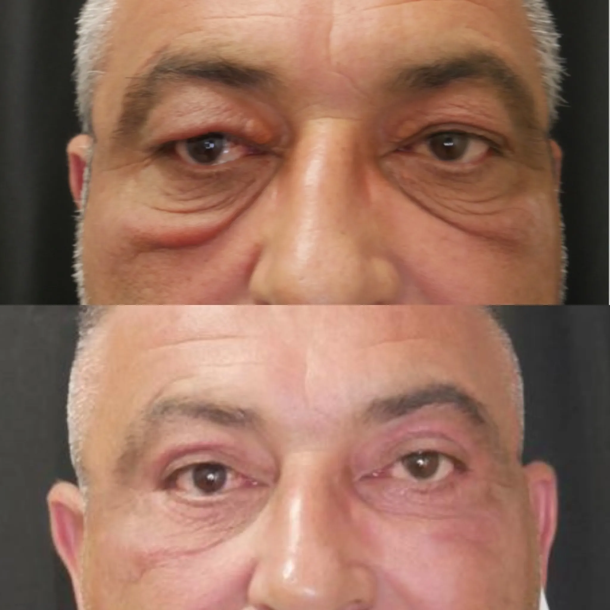 Upper & Lower Blepharoplasty Direct Festoon Excision, before and after, patient of Dr. Christine Bokman