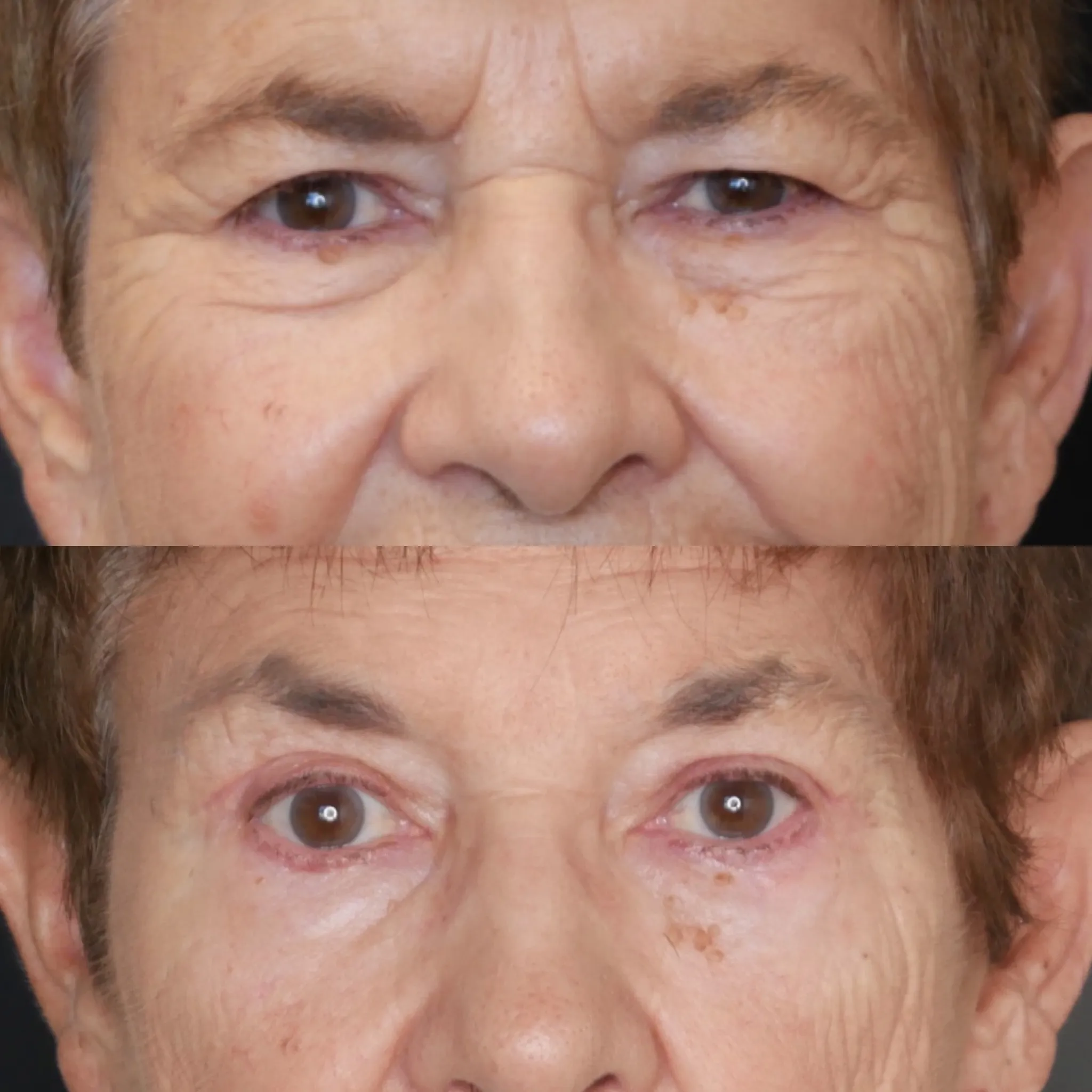 Upper Blepharoplasty, before and after, patient of Dr. Christine Bokman