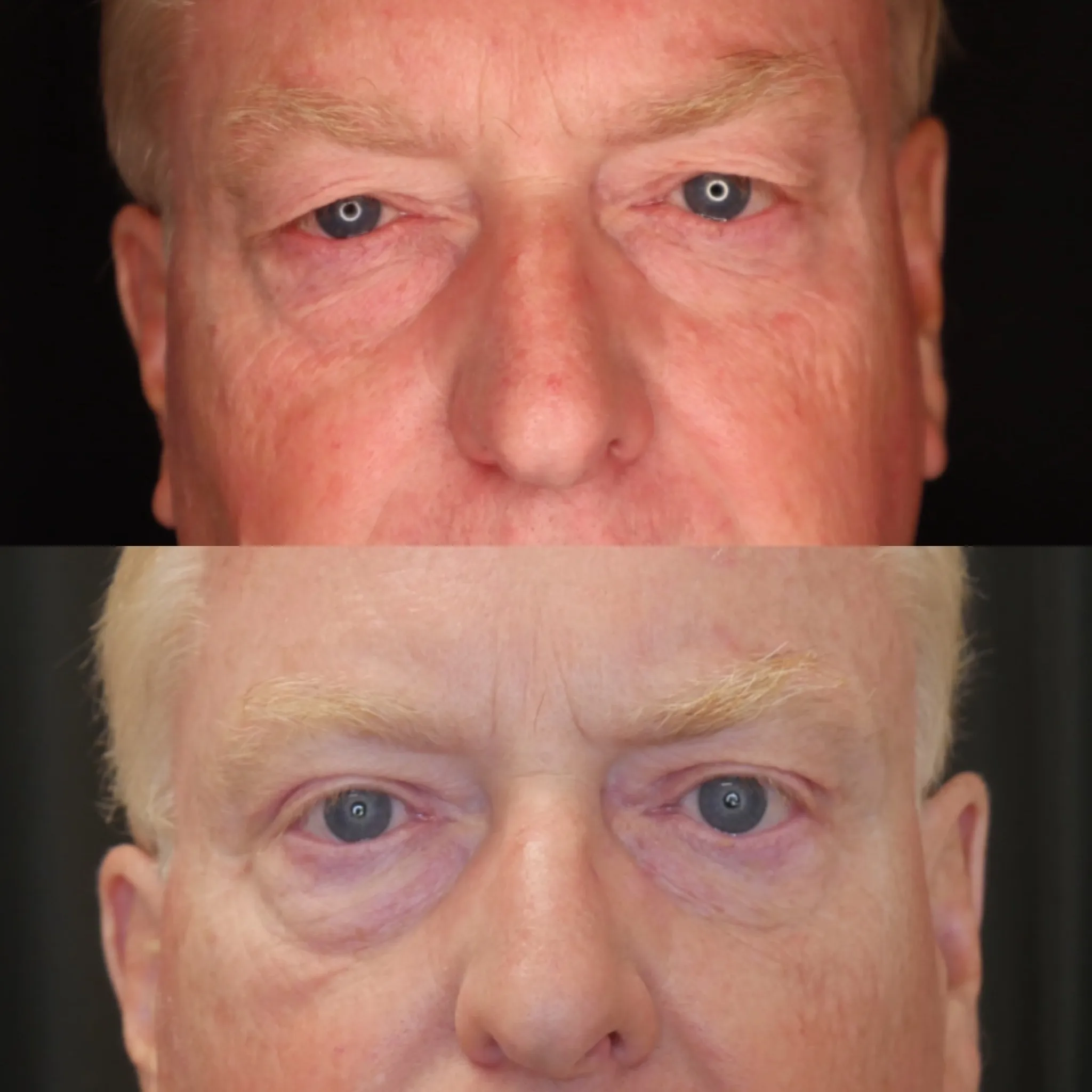 Upper Blepharoplasty, before and after, patient of Dr. Christine Bokman
