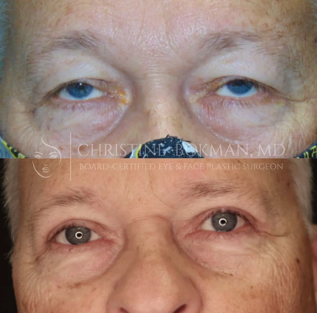 Upper Blepharoplasty, before and after, patient of Dr. Christine Bokman