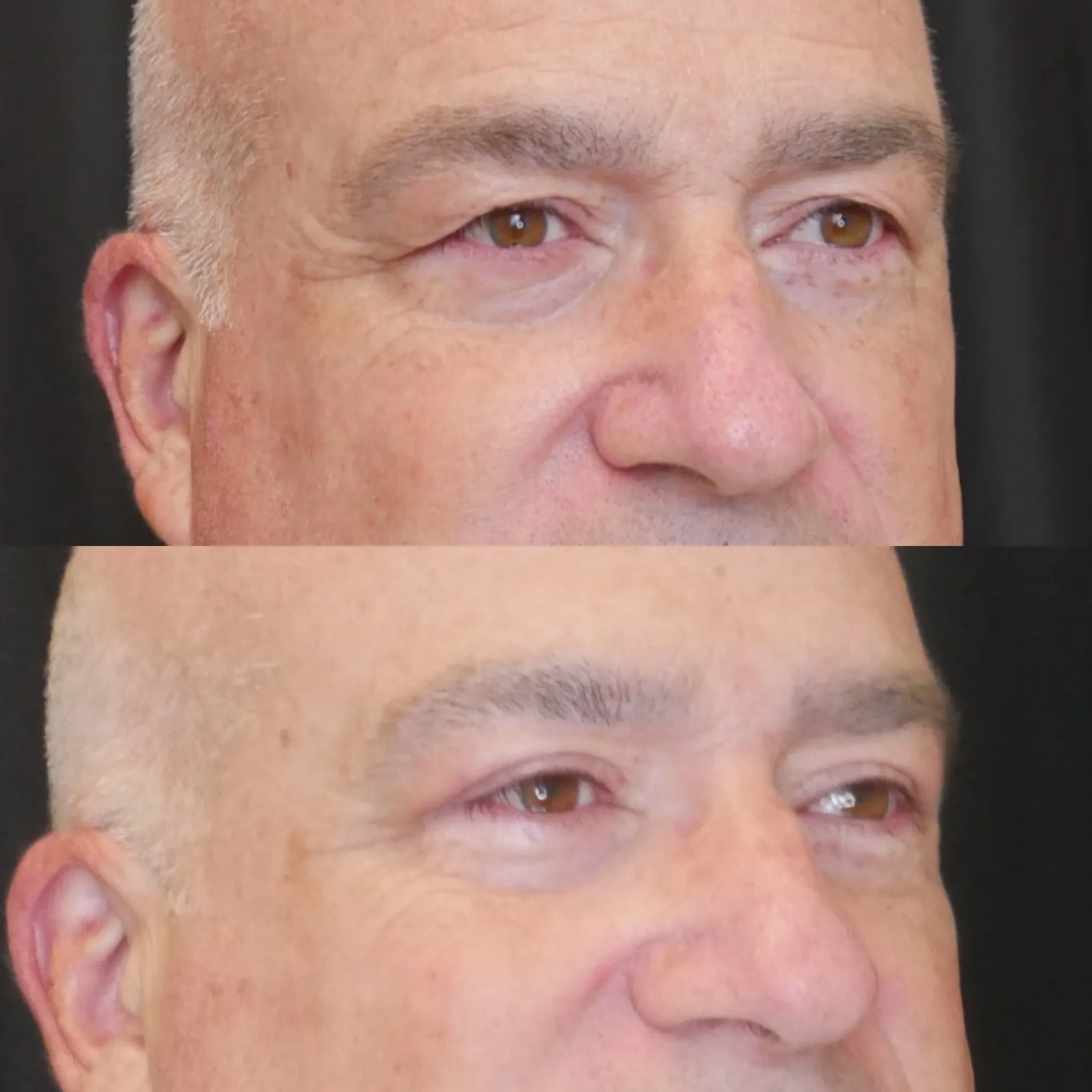 Upper Blepharoplasty, before and after, patient of Dr. Christine Bokman