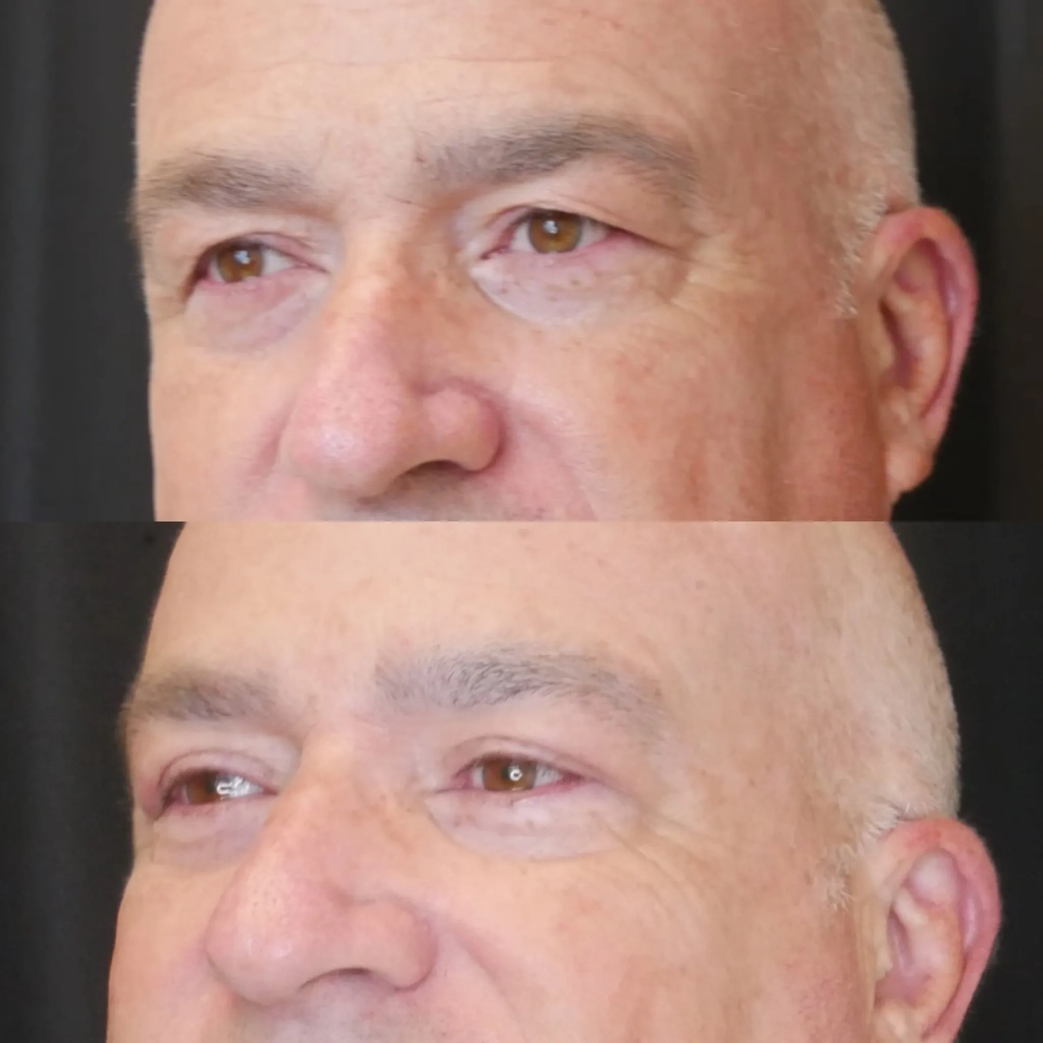 Upper Blepharoplasty, before and after, patient of Dr. Christine Bokman